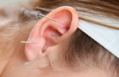 Island Acupuncture & Massage, Aricular Acupuncture