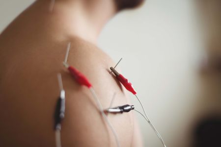 Island Acupuncture & Massage, Electro Acupuncture