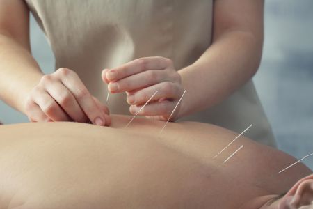 Island Acupuncture & Massage, Acupuncture
