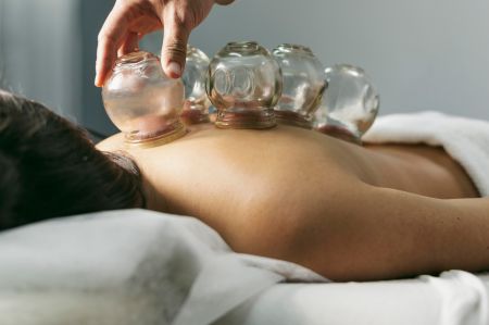 Island Acupuncture & Massage, Cupping