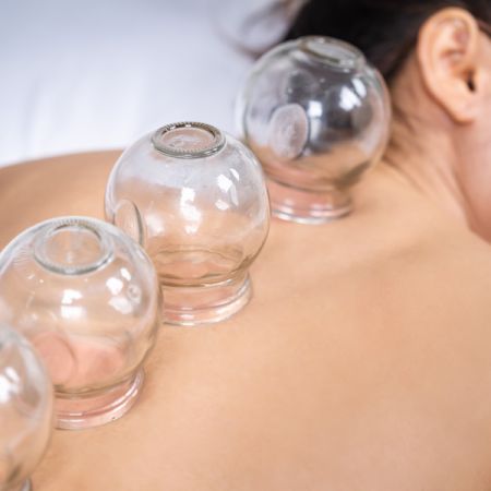 Island Acupuncture & Massage, Cupping