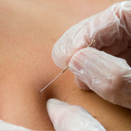 Island Acupuncture & Massage, Dry Needling