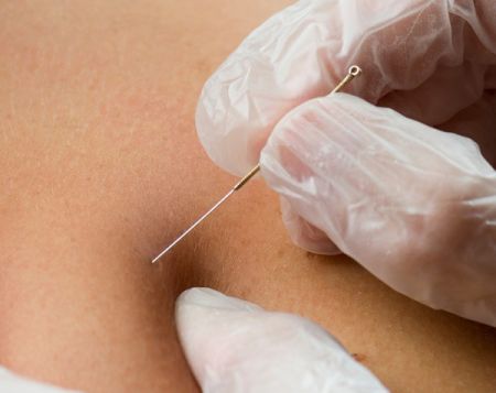 Island Acupuncture & Massage, Dry Needling